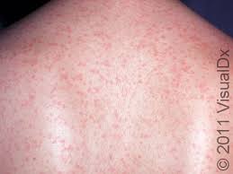 Image result for Rubella