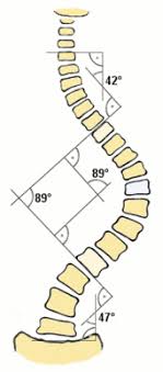 Scoliosis Wikipedia