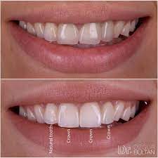 Grayish Zirconia Crowns Were Replaced With Ips E Max Restorations I Would Like To Place Non Prep Veneers On Canines Too Beautiful Teeth Dentistry Dental