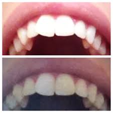 Therefore, of the possibility of such fixes without braces should speak with a dentist. I Have A Crooked Front Tooth What Are My Options Acld Seattle Advanced Cosmetic Implant Laser Dentistry Downtown Seattle