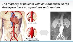 Abdominal Aortic Aneurysm Screening Prevention This bulge can rupture and cause internal bleeding.