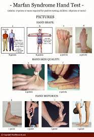 A Hand Test For Recognizing Marfan Syndrome Palm Reading Perspectives