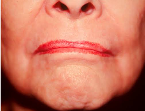 The upper lip margin becomes blunted with flattening of the philtrum... |  Download Scientific Diagram