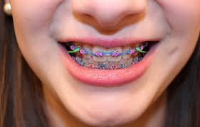 Hook the rubber band on the hook of the braces on the top teeth and pull the rubber band to the hook on the bottom teeth. Is It Really That Bad To Eat With Rubber Bands On Your Braces L M Orthodontics Orthodontists In Doylestown Glenside Perkasie Pa Warrington Bucks County Montgomery County