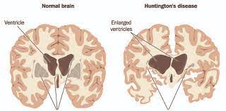 What Are The Signs And Symptoms Of Huntington S Disease Bridge Clinic