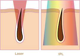 Ipl and laser hair removal do not produce the same results. Ipl Vs Laser What S The Difference Smoothskin