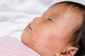 Image result for measles