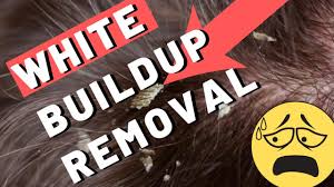 Sebum, skin flakes, pollution, and product buildup. 2 Fast Ways To Get Rid Of White Build Up On Scalp