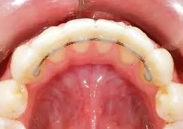 But how fast are they and how long will it take until invisalign aligners close a gap? Invisalign Retainer All You Need To Know Smile Stories