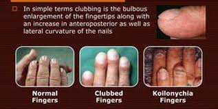 Image result for Clubbing nails feet