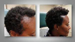 Stress is a common cause of hair loss in african american women. New Research Alert Hair Loss In Women Video Abc News