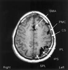 Agraphia An Overview Sciencedirect Topics