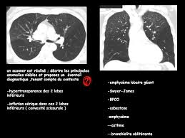 La bronchiolite oblitérante avec pneumopathie d'organisation. 20 Questions A Reponses Ouvertes Et Courtes Qroc Ppt Telecharger