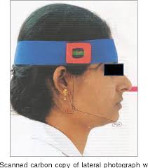 Freeway space determination using lateral profile photographs: A pilot  study