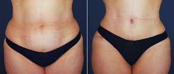 Knowing what to expect will help you in planning. What S The Key To A Superb Natural Looking Tummy Tuck It S All In The Belly Button Inland Cosmetic Surgery