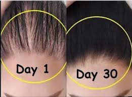 Once you spray on the solution, simply massage it into your scalp (which we learned earlier will also promote hair growth). What Are The Ways To Make Your Hair Dense Quora