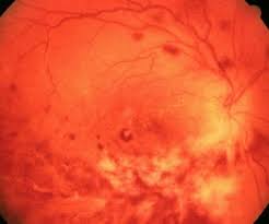 Image result for HIV Retinitis