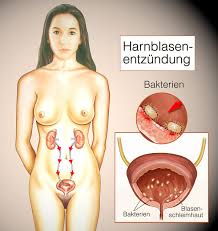 Blasenentzundung Zystitis Ursache Symptome Behandlung Ksw