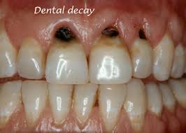 National Smile Month at Time Dental in Farnham, Surrey describes the cause of tooth decay and tips on preventing it.