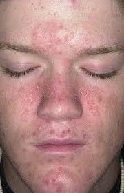 3ヶ月で治る顔の脂漏性皮膚炎 アトピー攻略ブログ 脂漏性皮膚炎 皮膚炎 治る