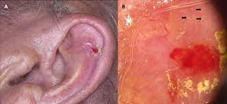 It affects people of all races, genders and ages, which is why it's absolutely critical for americans to learn about. Clinical And Epidemiological Analysis Of Basosquamous Carcinoma Results Of The Multicenter Study Scientific Reports