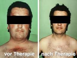 Cushing Syndrom Beschwerden Untersuchungen Behandlung
