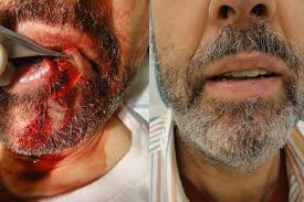 Or the doctor may need to remove the stitches in about 3 to 5 days. Do You Need Stitches For That Cut Lara Devgan Md Mph Facs