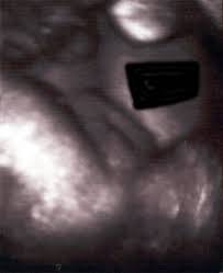 Kumpulan gambar bayi perempuan lucu yang di foto saat masih baru lahir dan masih bayi balita. Sejauh Mana Ketepatan Ultrasound Mengesan Jantina Dr Zubaidi Hj Ahmad Menulis