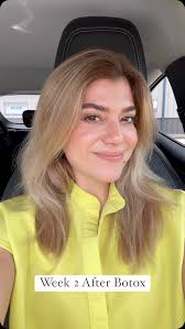 💉Check out our PA Ximena’s amazing results! , 🌟 Before and after Botox:  smooth, refreshed, and radiant!, 🧖‍♀️Botox not only helps reduce wrinkles  but also gives a natural, youthful glow. Book now for ...