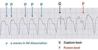 Pin On Ecg