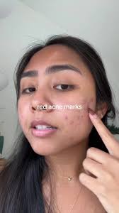 Effective Solutions for Red Acne Marks and Scars