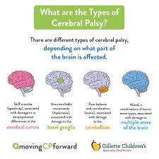 What Are The Types Of Cerebral Palsy Infographic By Gillette