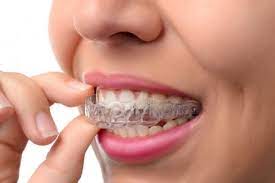 We cover all brace prices in the uk and offer our own exceptional brace solutions. How Much Does Invisalign Cost Uk Invisalign Braces Cost Angel Orthodontics
