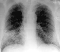 Bacterial pneumonia is an infection of your lungs caused by certain bacteria. Radiology Of Bacterial Pneumonia Sciencedirect