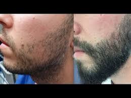 Epstein js, bared a, kuka g. 801 Fu S Beard Hair Transplant By Fue Technique 1420 2015 Youtube