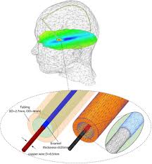 687 articole new era alese de tine de la 16 magazine online. Reducing Rf Induced Heating Near Implanted Leads Through High Dielectric Capacitive Bleeding Of Current Cbloc Biorxiv