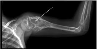 Image result for Ewing Sarcoma