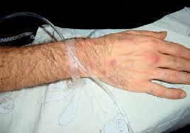 Pathergy is an exaggerated skin injury occurring after minor trauma such as bump, bruise, needle stick injury. A Positive Pathergy Test Which Manifests Within 48 H As An Erythematous Download Scientific Diagram