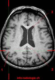 Image result for Parietal Lobe