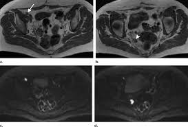 Management of epithelial ovarian cancer; Recurrent Ovarian Cancer In A 65 Year Old Woman A B Axial Download Scientific Diagram