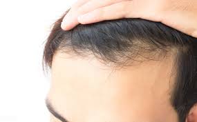 There seems to be another type of traditional chinese medicine which has been claimed by chinese natives known as hua shen gen (chinese soup) which is supposed to help increase the growth process and make still growing teenagers taller than if they didn't use the herb. The Hairline Shifts Back And Loses Hair Again These 4 Reasons May Be The Reason Try Chinese Medicine For External Washing And Food Supplement For Hair Growth Minews