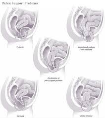 Pelvic Prolapse Non Surgical Treatment