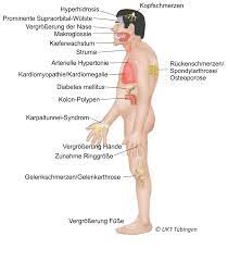 Tumoren Der Hypophyse Uniklinik Tubingen Neurochirurgie