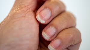 Image result for Nail Pitting