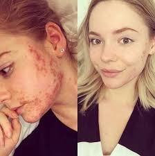 Rachel Hat Keine Akne Mehr Seit Sie Auf Dieses Essen Verzichtet Hat Dieses Essen Keine Rachel Verzichtet Akne Akne Therapie Zystische Akne