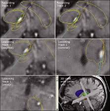Image result for Pallidotomy