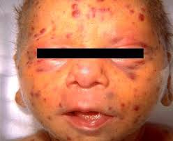 Image result for Rubella