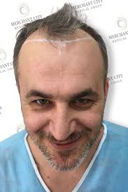 Hair Transplant