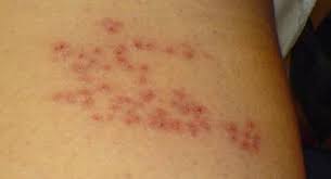 773,525 likes · 18,158 talking about this. Herpes Related Skin Rashes Fastmed Urgent Care