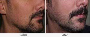 Using minoxidil speeds beard growth and development and allows faster results! Men Issues Can Dermarolling Stimulate Beard Growth Derma Roller Shop
